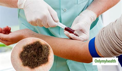 is there a blood test for melanoma cancer